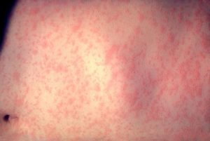 Measles Symptoms Pictures