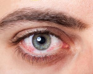 red watery eyes signs of measles