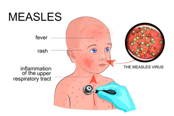 measles rash picture