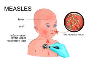 measles image