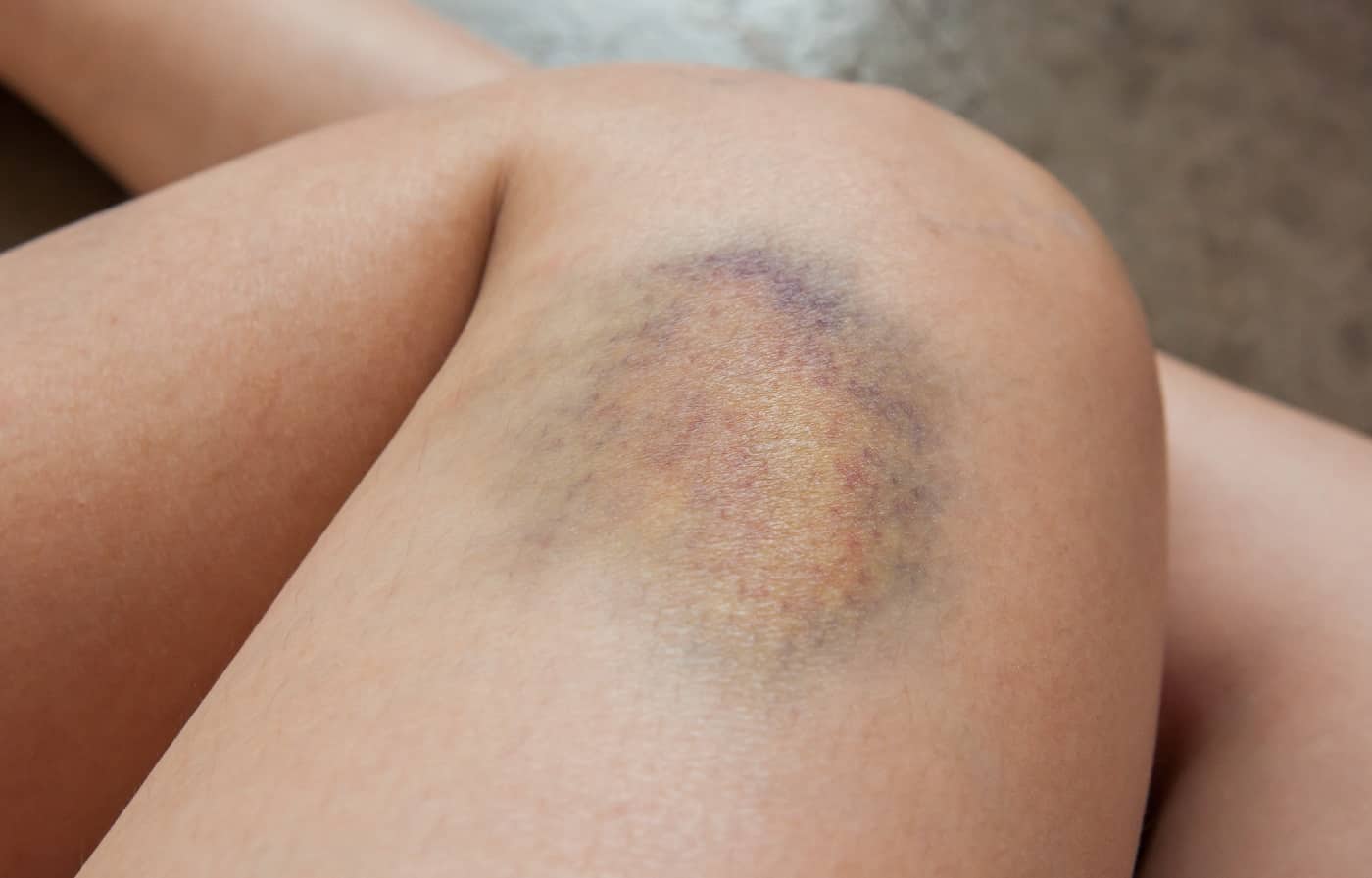 Knee with bruise
