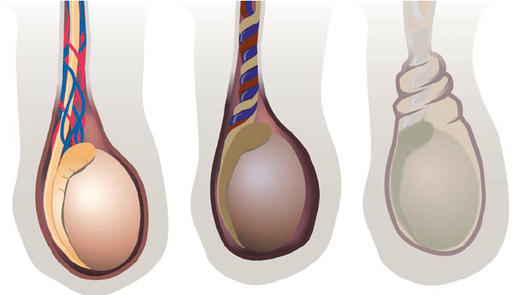Diagram of testicular torsion