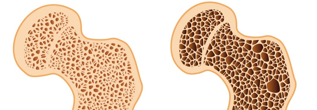 porous bone